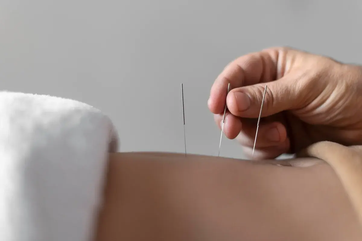 acupuncture